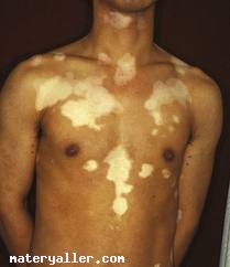 Addison Hastalığı